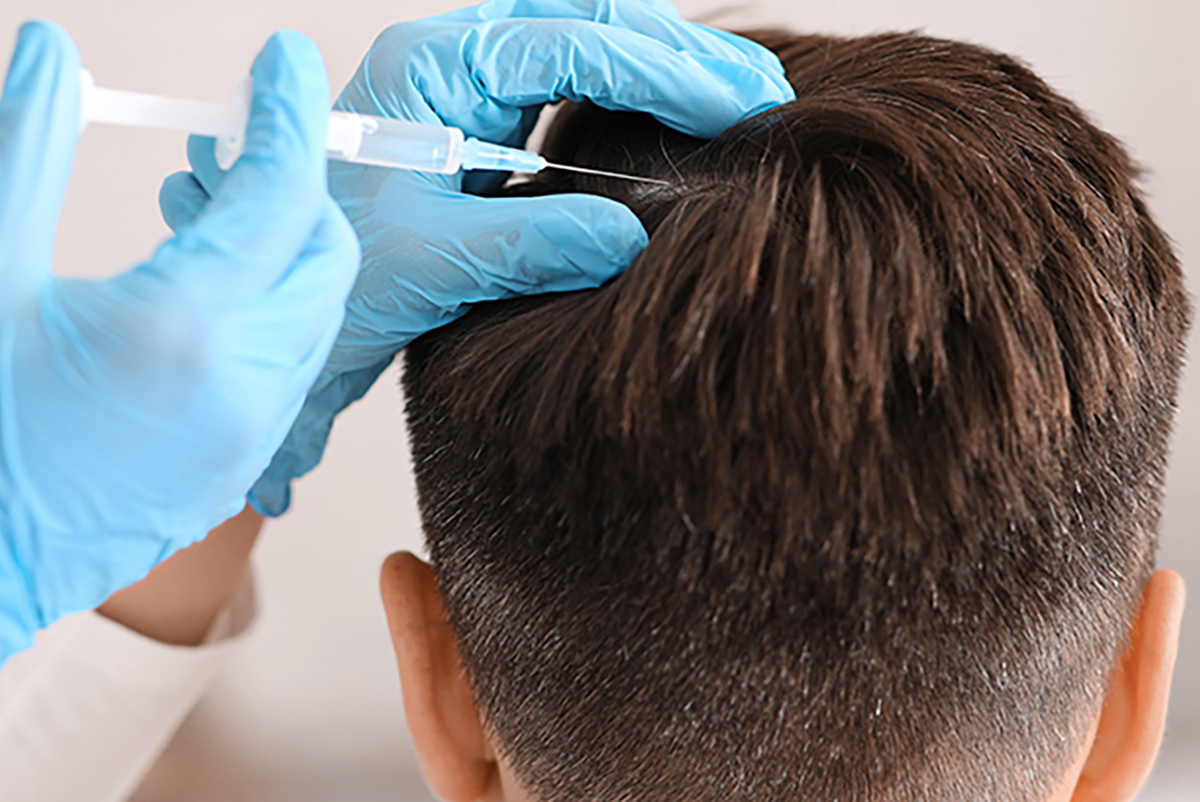 When can I return to work following a hair transplant? - next gen