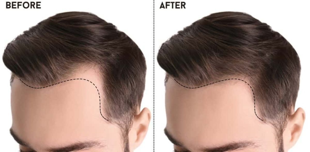 Hair Transplant Turkey