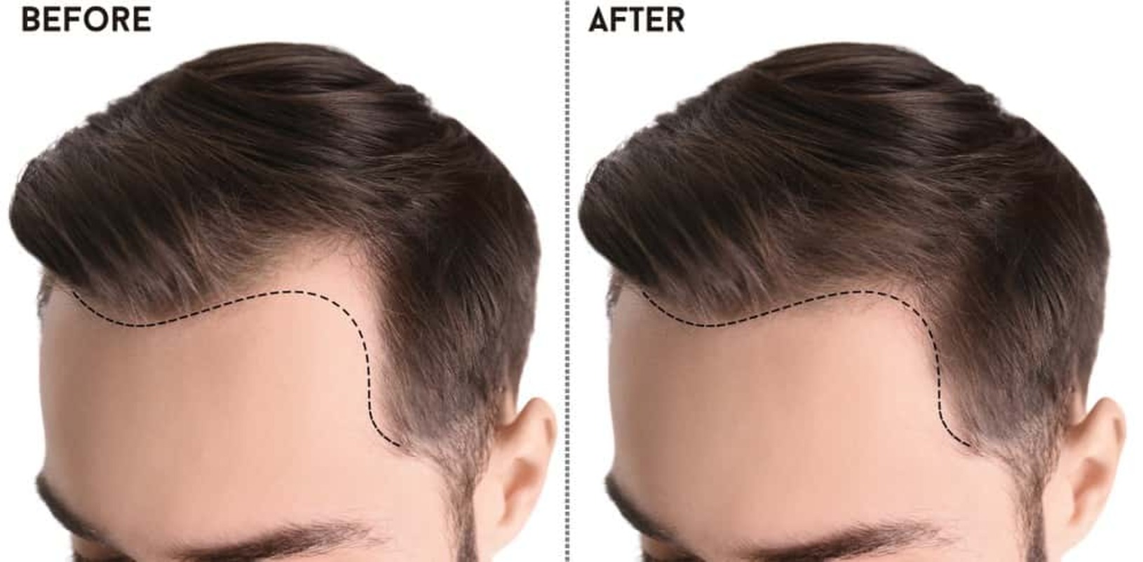 Before & After Hair Transplant Surgery in London | Omniya Clinic