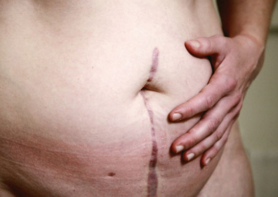 Tummy-Tuck-surgery-3