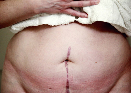 Tummy-Tuck-surgery-4