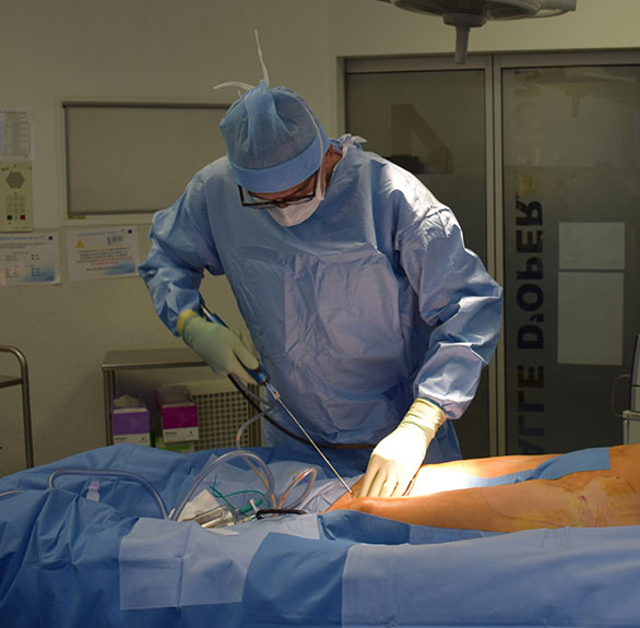 liposuction-surgery