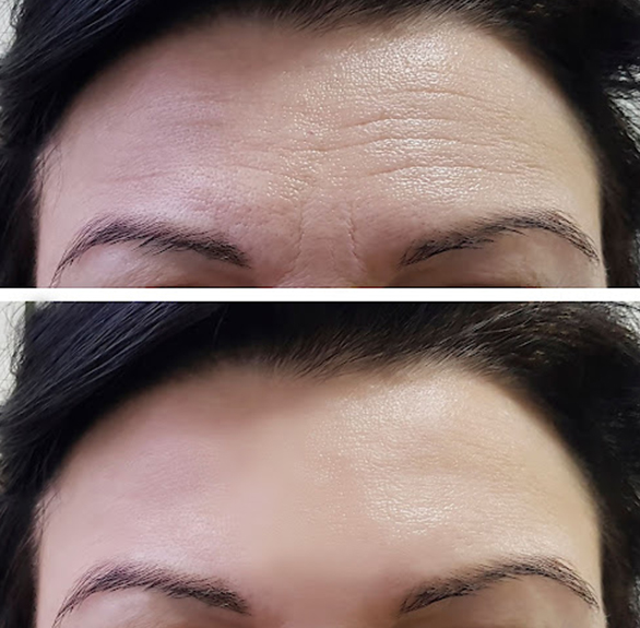 brow-lift-before-after-img-586