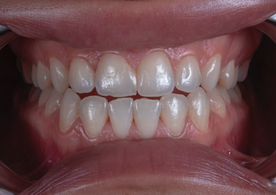 veneers-teeth-img-504