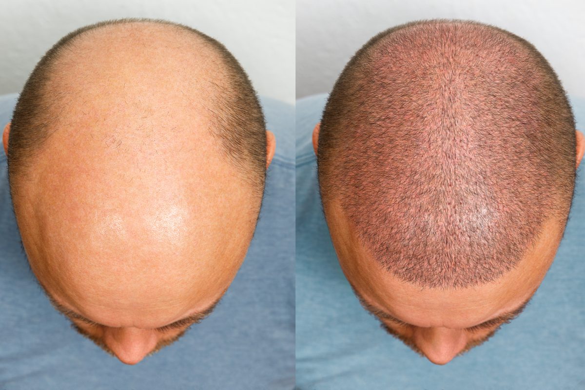 Hair Transplant Regrowth