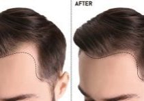 Hair Transplant Turkey