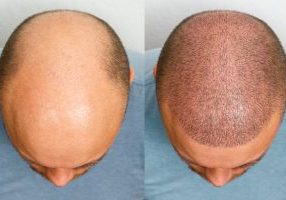 Hair Transplant Regrowth